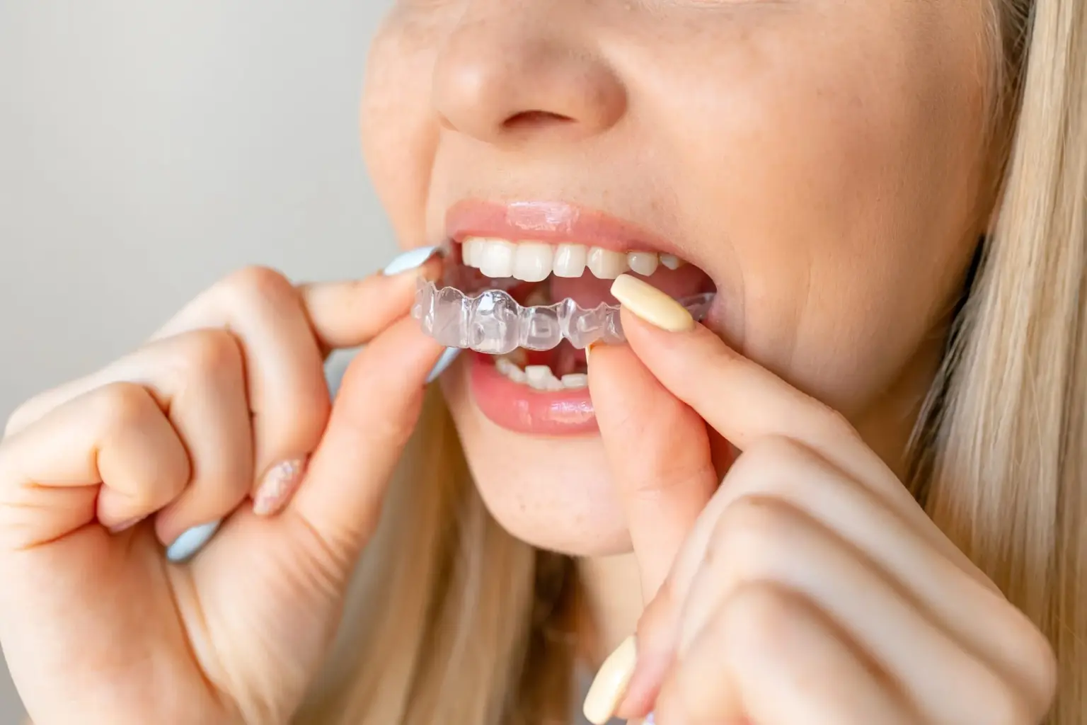 closeup of a young woman putting in her Invisalign to fix overbite