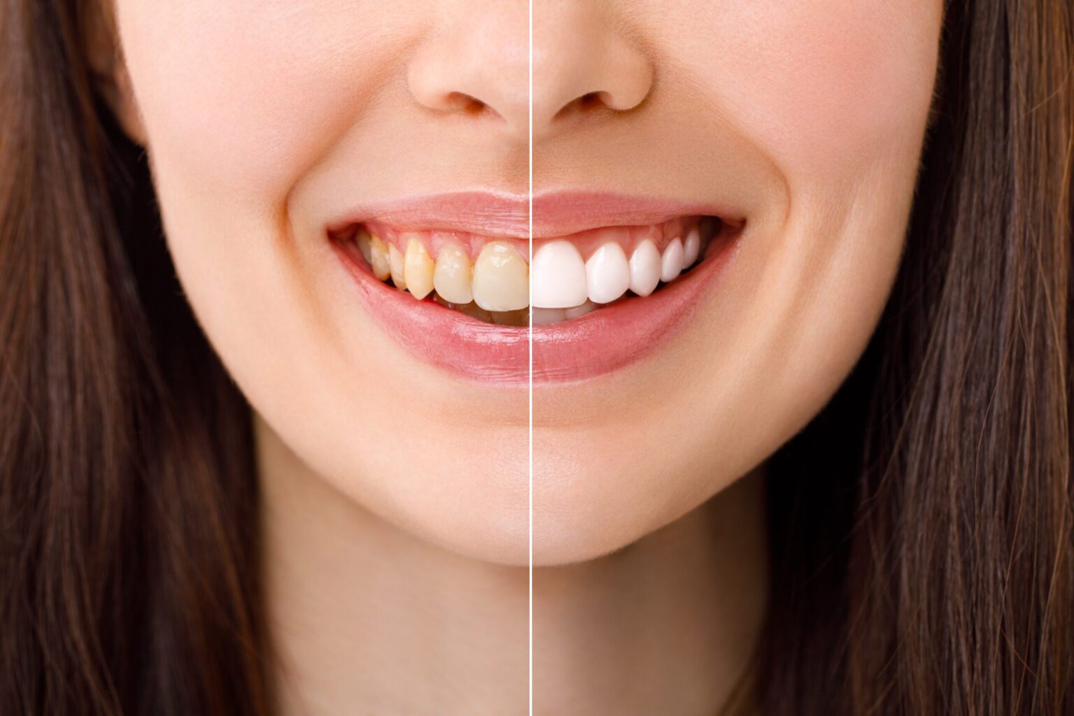 before and after professional teeth whitening treatment